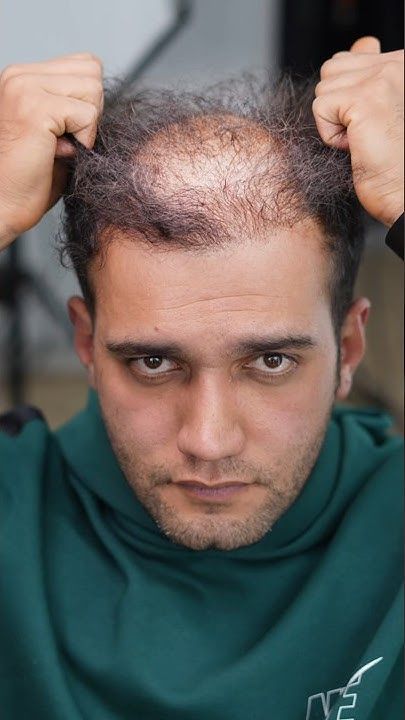 Hair Loss Treatment Gorakhpur