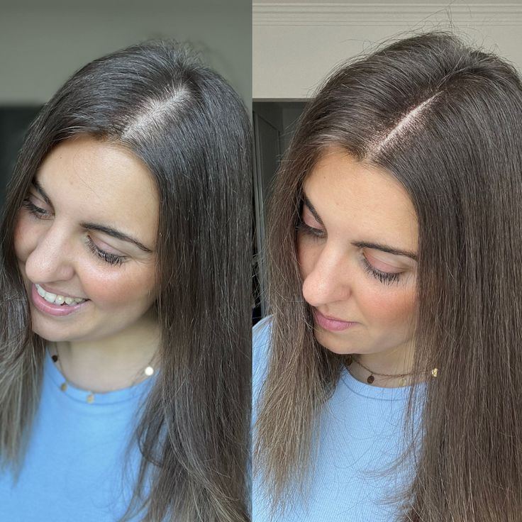 Baldness Solution Gorakhpur