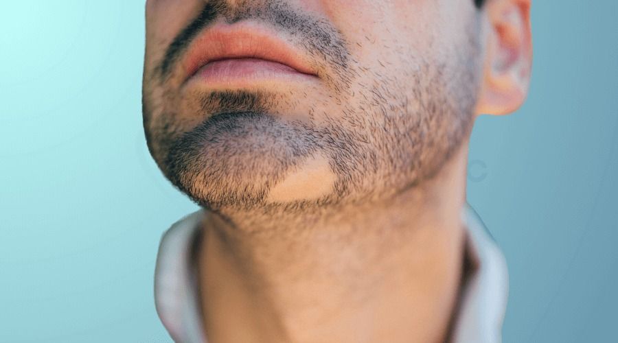Beard Micropigmentation Results