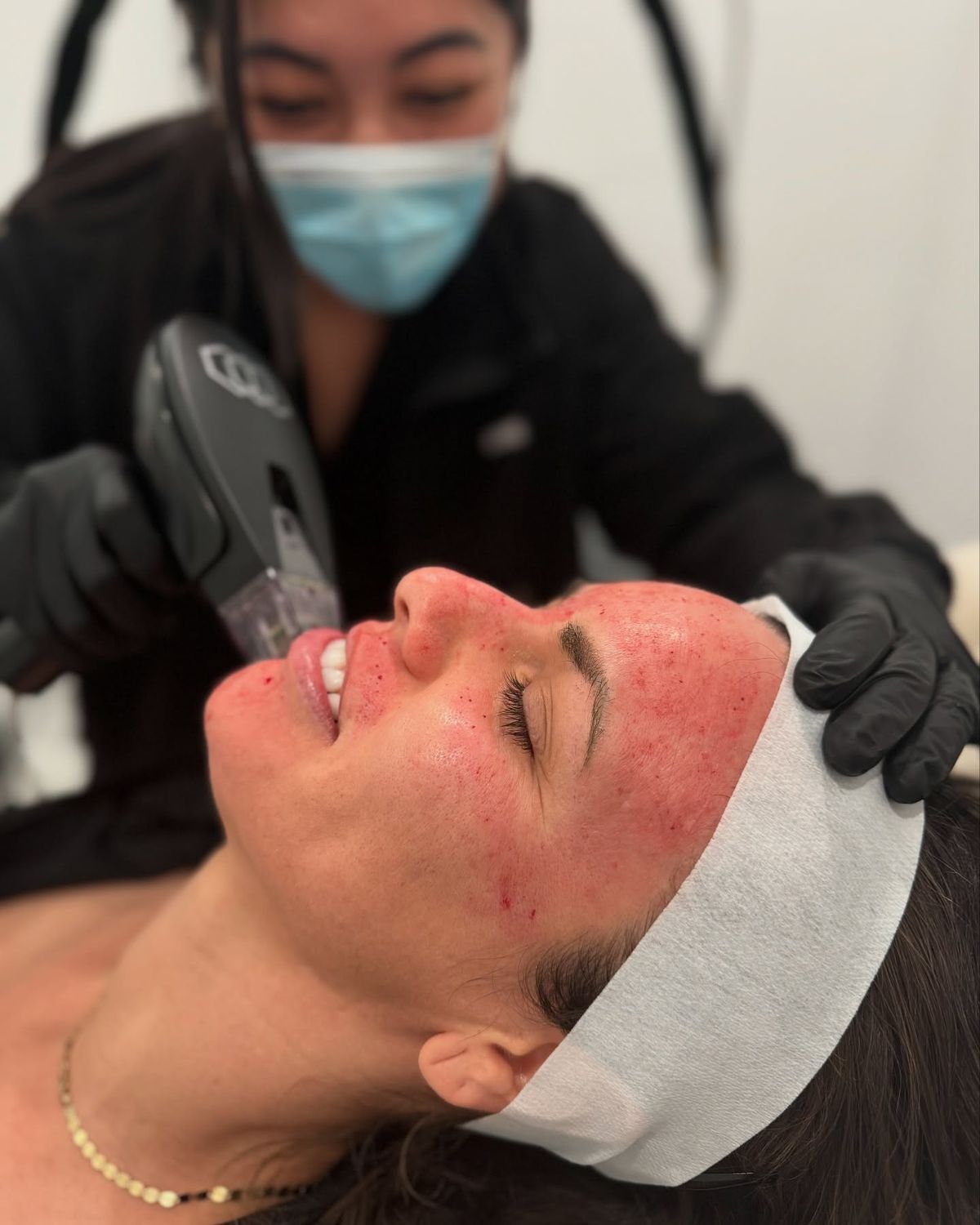 Sun Age Spots Treatment Gorakhpur