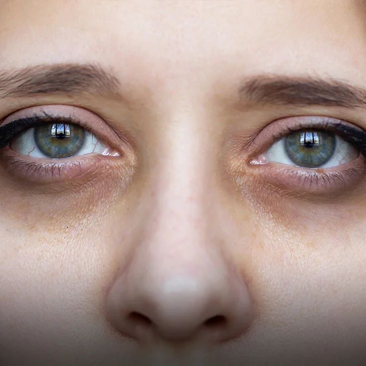 Dark Circle Treatment KM Orgatonics