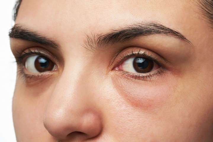 Under Eye Wrinkle Repair Gorakhpur