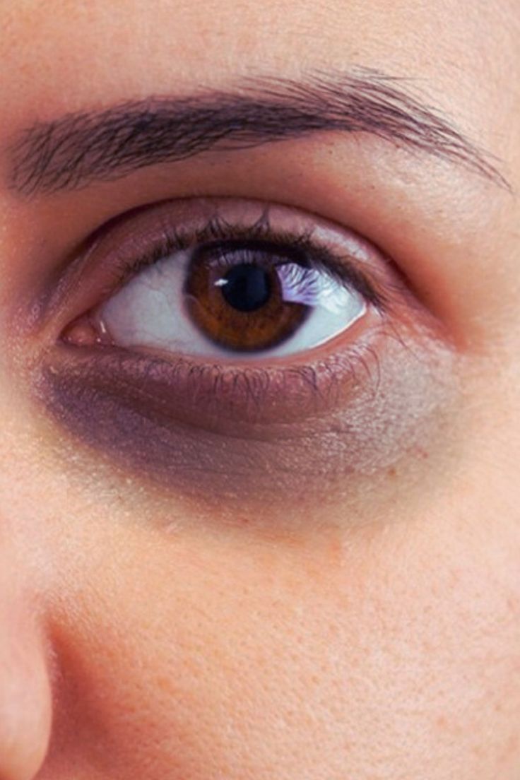 Eye Rejuvenation Results – Brightened and Refreshed Under-Eyes at KM Orgatonics Gorakhpur