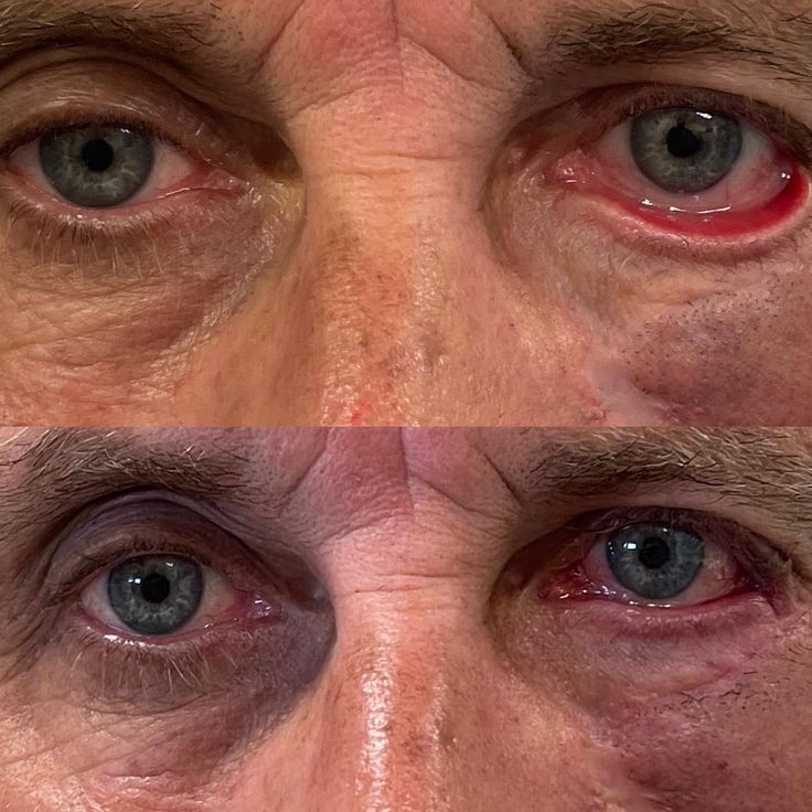 Center bottom wide image - Eyelid Augmentation results