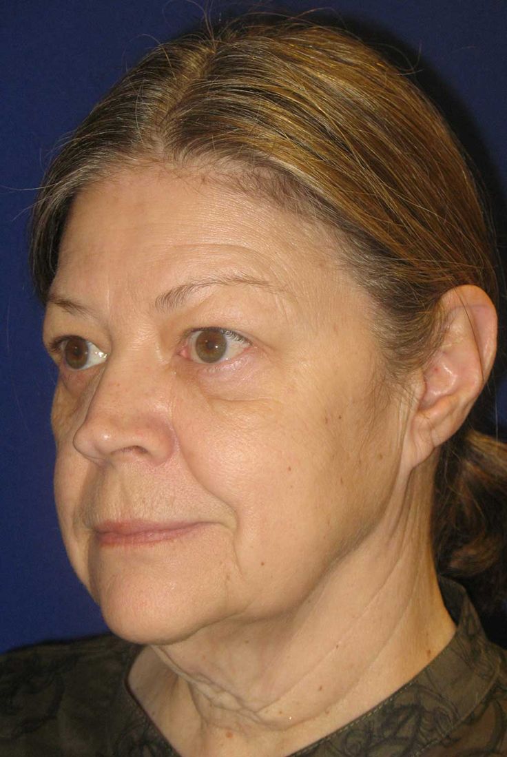 Fluid Facelift before and after left view
