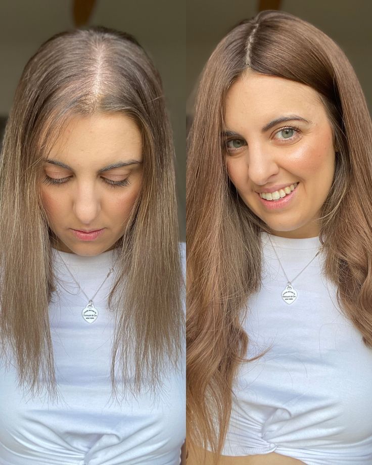 Non-Surgical Hair Replacement Gorakhpur