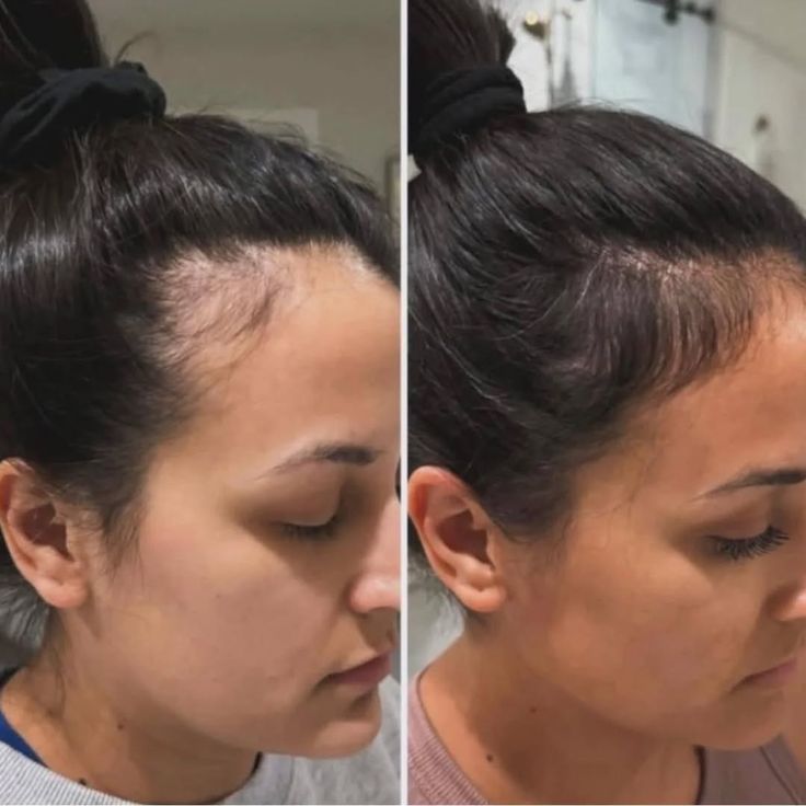 Scalp Detox Hair Transformation - Before & After 3
