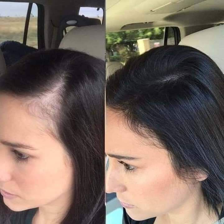 Scalp Detox Hair Transformation - Before & After 4