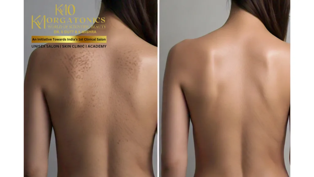 Before & after image showcasing the effectiveness of a back treatment at KM Orgatonics. The "before" image shows a back with noticeable blemishes and uneven skin tone. The "after" image reveals significantly smoother, clearer, and more even-toned skin.