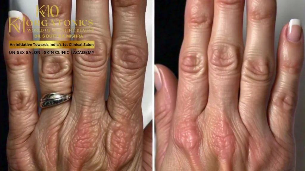 Before & after photos of a hand demonstrating the rejuvenating effects of a skin treatment at KM Orgatonics. The "before" image shows wrinkled and aged skin on the hand. The "after" image reveals smoother, plumper, and more youthful-looking skin.